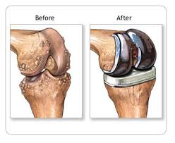 Factors to Consider Before Undergoing Knee Replacement in Mumbai